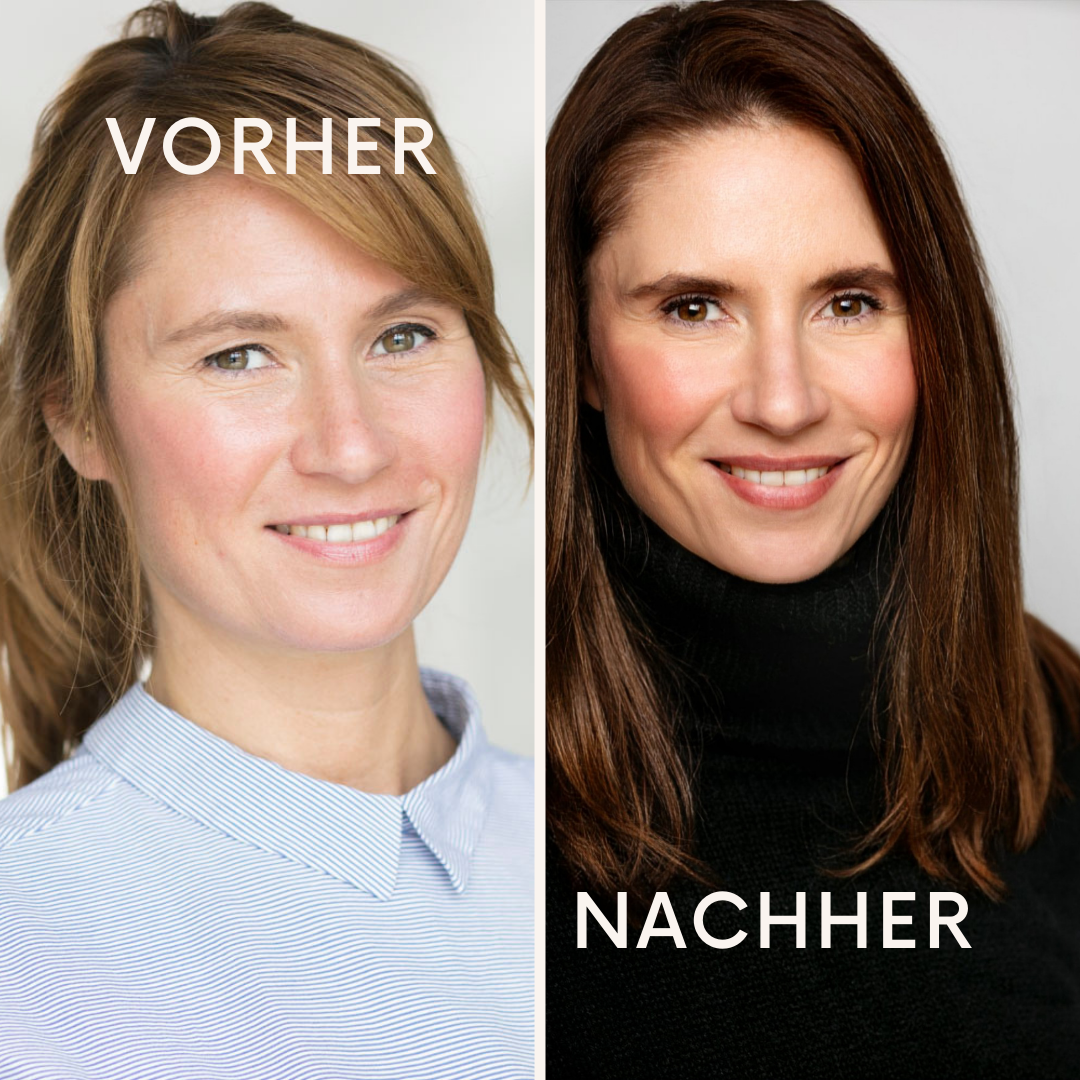 Vorher-Nachher-Bild einer Oberlidstraffung bei Frau Mitte 30. Sichtbare Verbesserung der Augenpartie nach ästhetischem Eingriff.