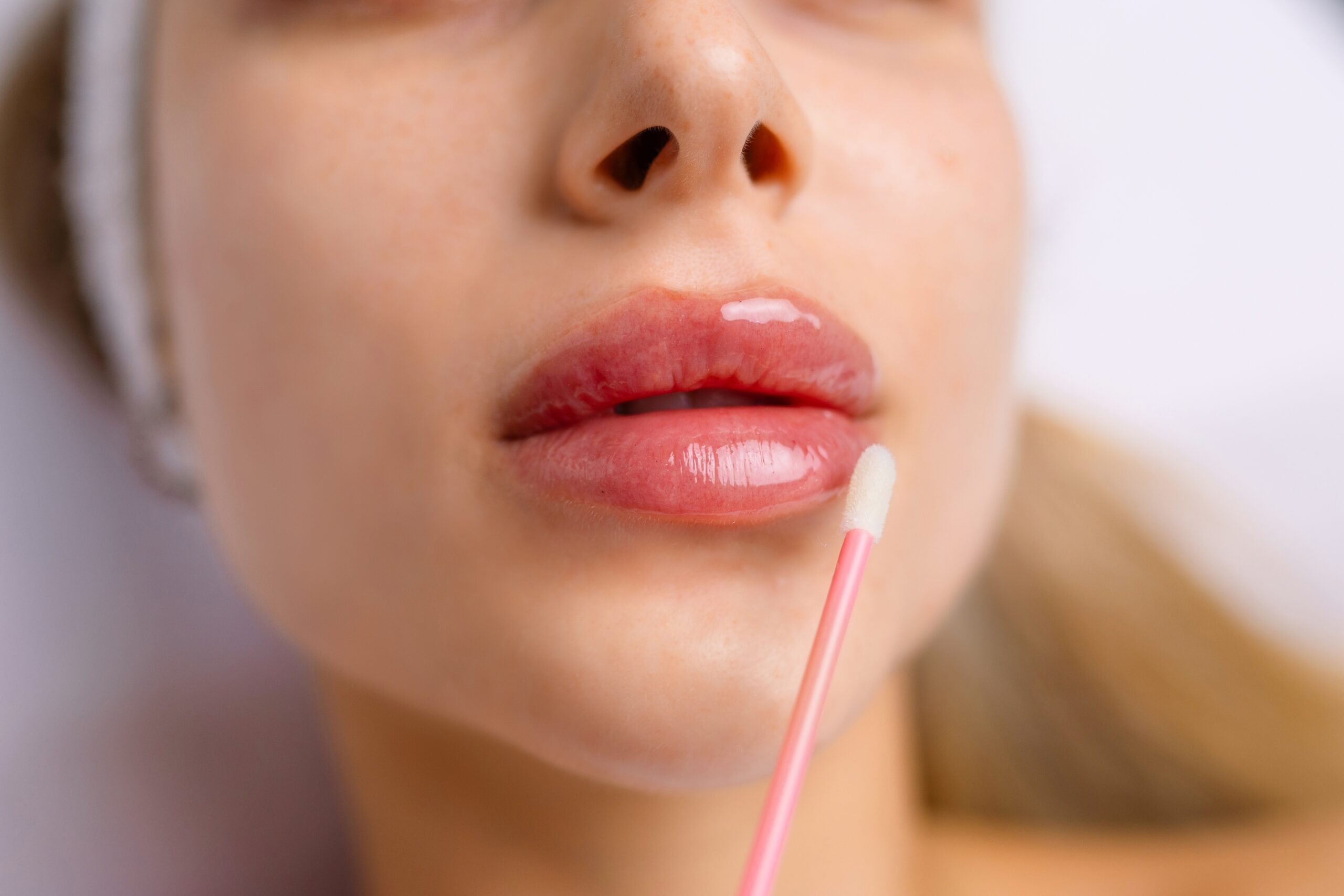 Frau nach Lippen aufspritzen in Berlin und Düsseldorf natürliches Ergebnis einer Hyaluron-Behandlung