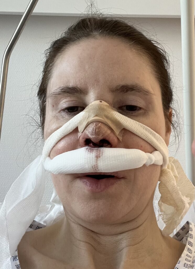 Postoperatives Bild nach ästhetischer Nasenkorrektur – Schwellung und Nasenschiene sichtbar.