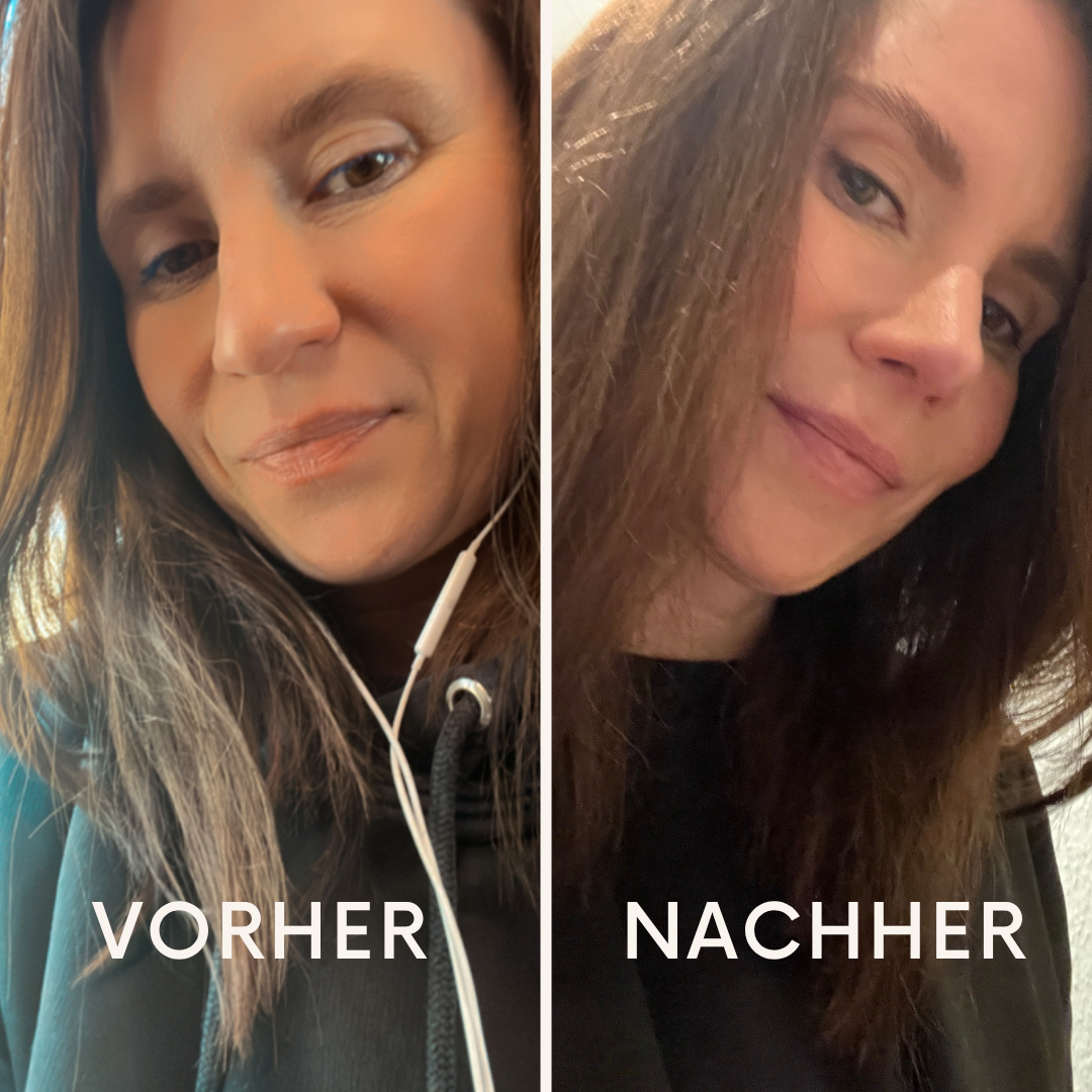 Vorher-Nachher-Bild einer ästhetischen Nasenkorrektur nach 3 Monaten. Erfahrungsbericht mit Heilungsverlauf und OP-Ergebnis