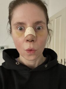 Portrait nach vier Schönheitsoperationen: persönliche Erfahrungen mit ästhetischen Eingriffen